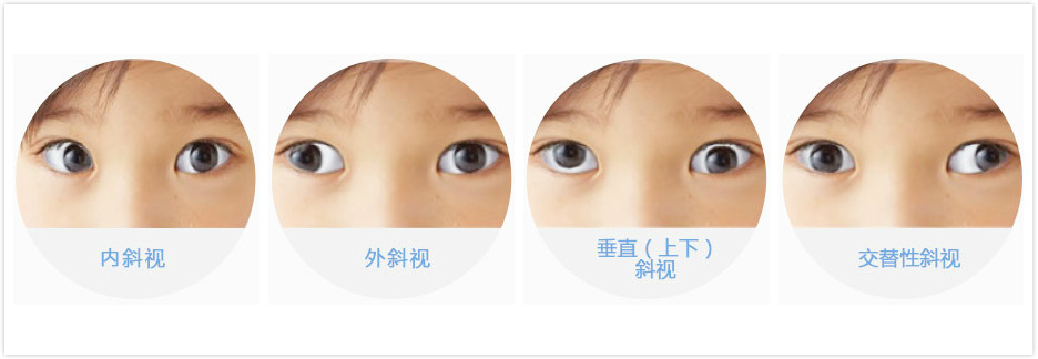 小孩斜弱视如何？
