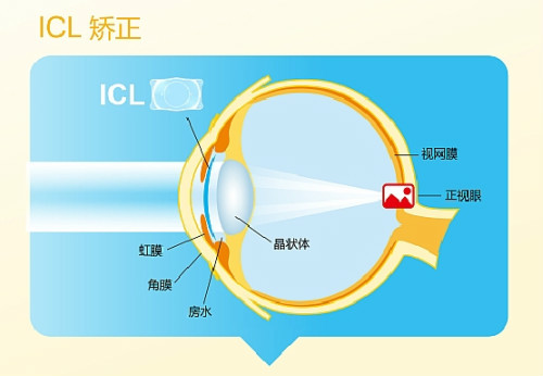 近视眼激光手术有哪些？专家告诉你哪种手术适合你