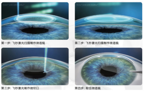 近视眼激光手术费用大概是多少钱?