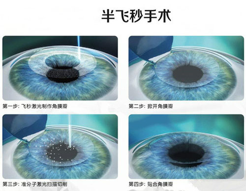 近视眼激光手术有哪些？专家告诉你哪种手术适合你