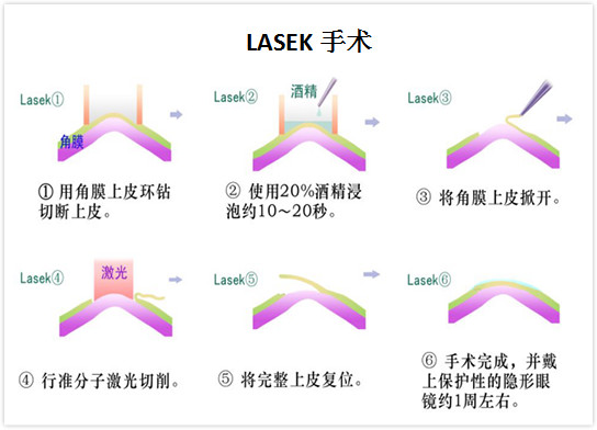 近视眼激光手术有哪些？专家告诉你哪种手术适合你