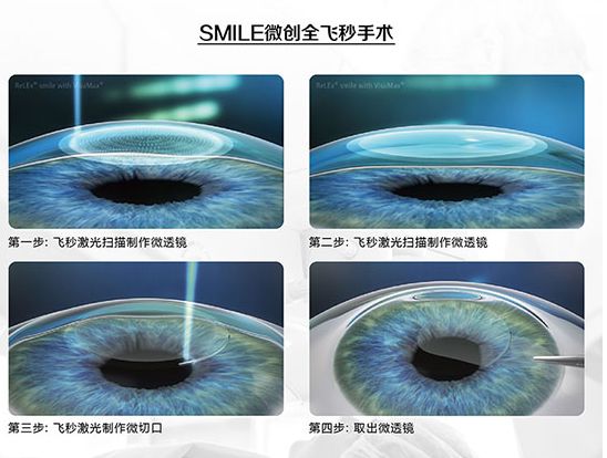 哪些近视人群适合做全飞秒激光近视手术？