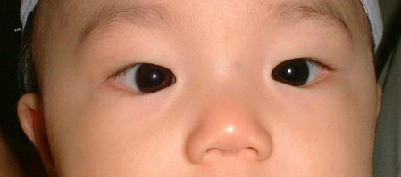 小孩斜视有什么危害?