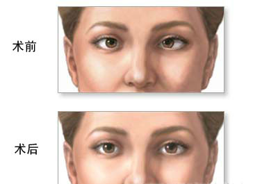 成人斜弱视需要多少钱？如何？